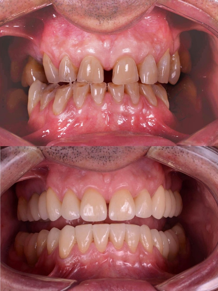 facette dentaire avant après très naturel homme