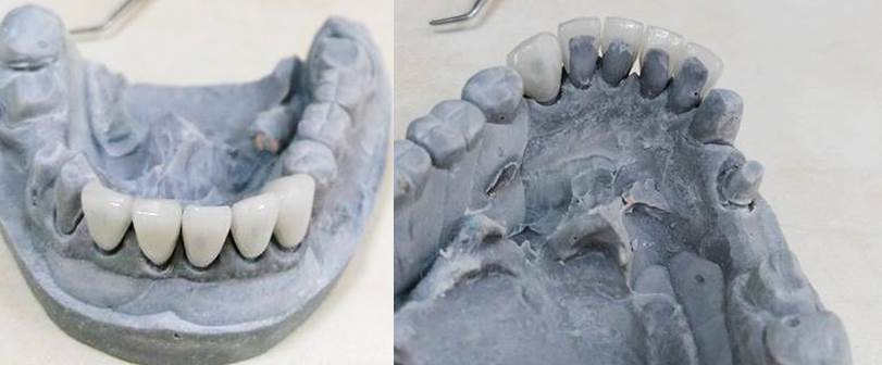 facette dentaire avant pose sur modèle