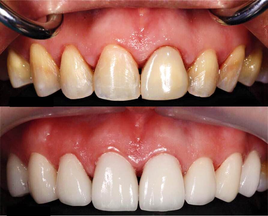 facette dentaire résultat avant après