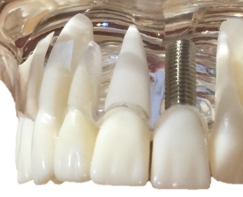 gros plan sur un modèle visuel implant dentaire