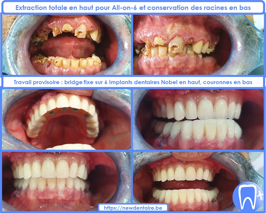 implant dentaire et charge immédiate de prothèses complètes