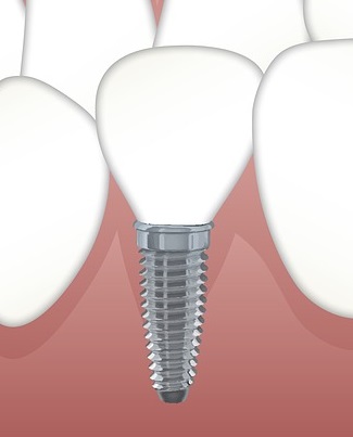 implant dentaire