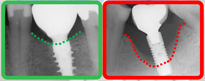 perte osseuse implant dentaire