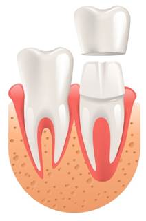 Couronne dentaire