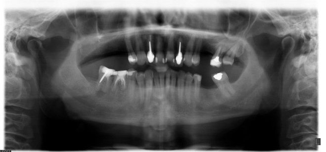 Radiographie panoramique dentaire