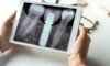 Dent sur pivot - Implant dentaire