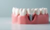 Tout savoir sur le prix d'un implant dentaire