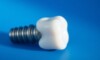 Implant dentaire sur fond bleu.