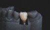 Clinique dentaire réalisant implant dentaire à liège